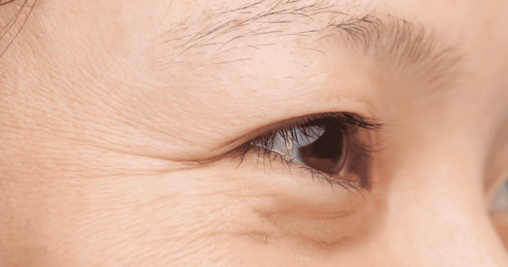 wrinkles